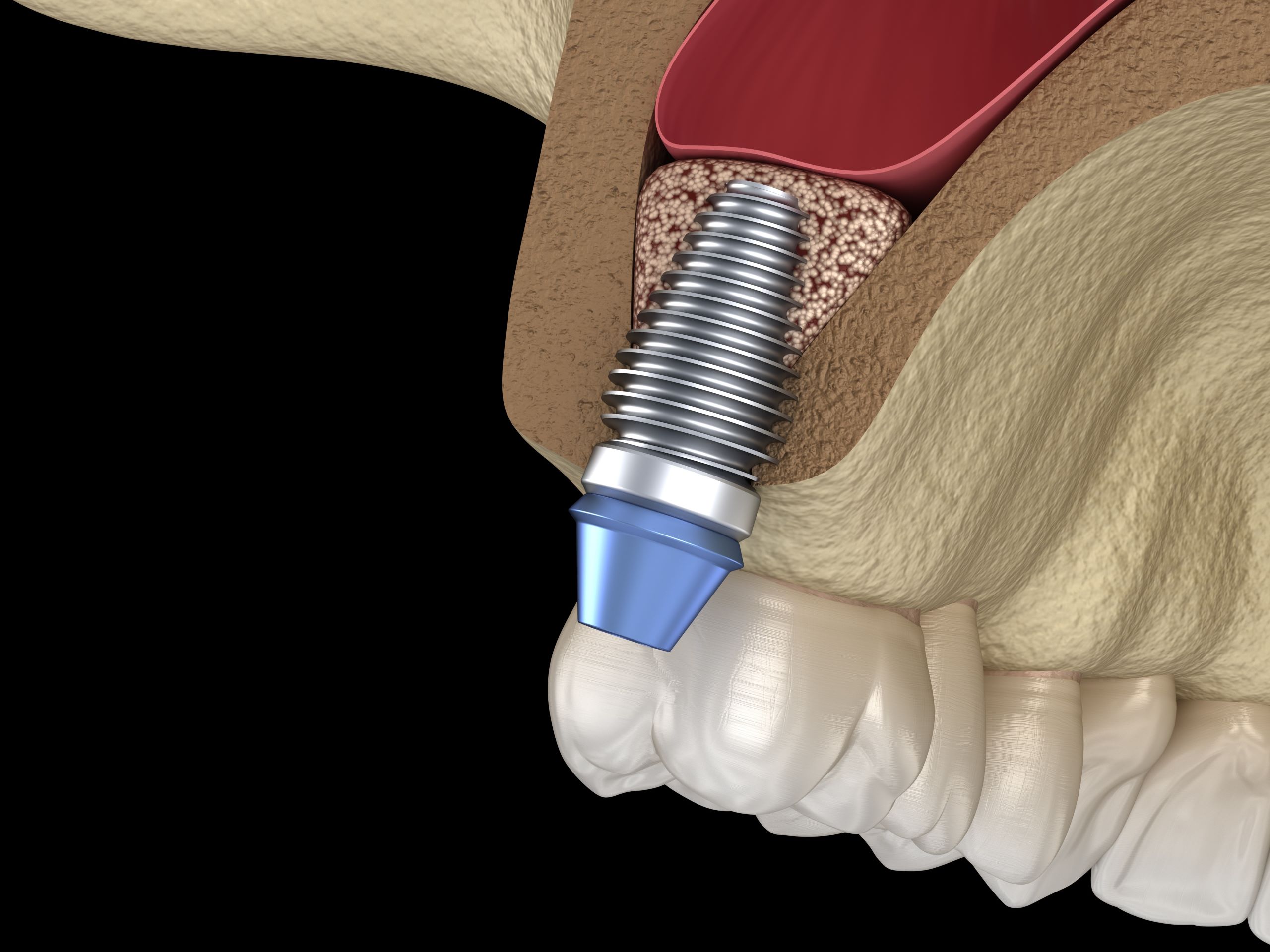 Osspore Sinus-implant bone
