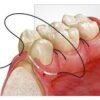 dental Surgical sutures